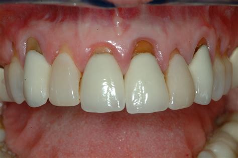 gum graft henderson nv